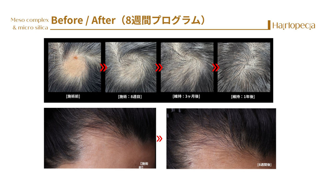 ヘアロペーシア（頭皮ケア用スピキュール）