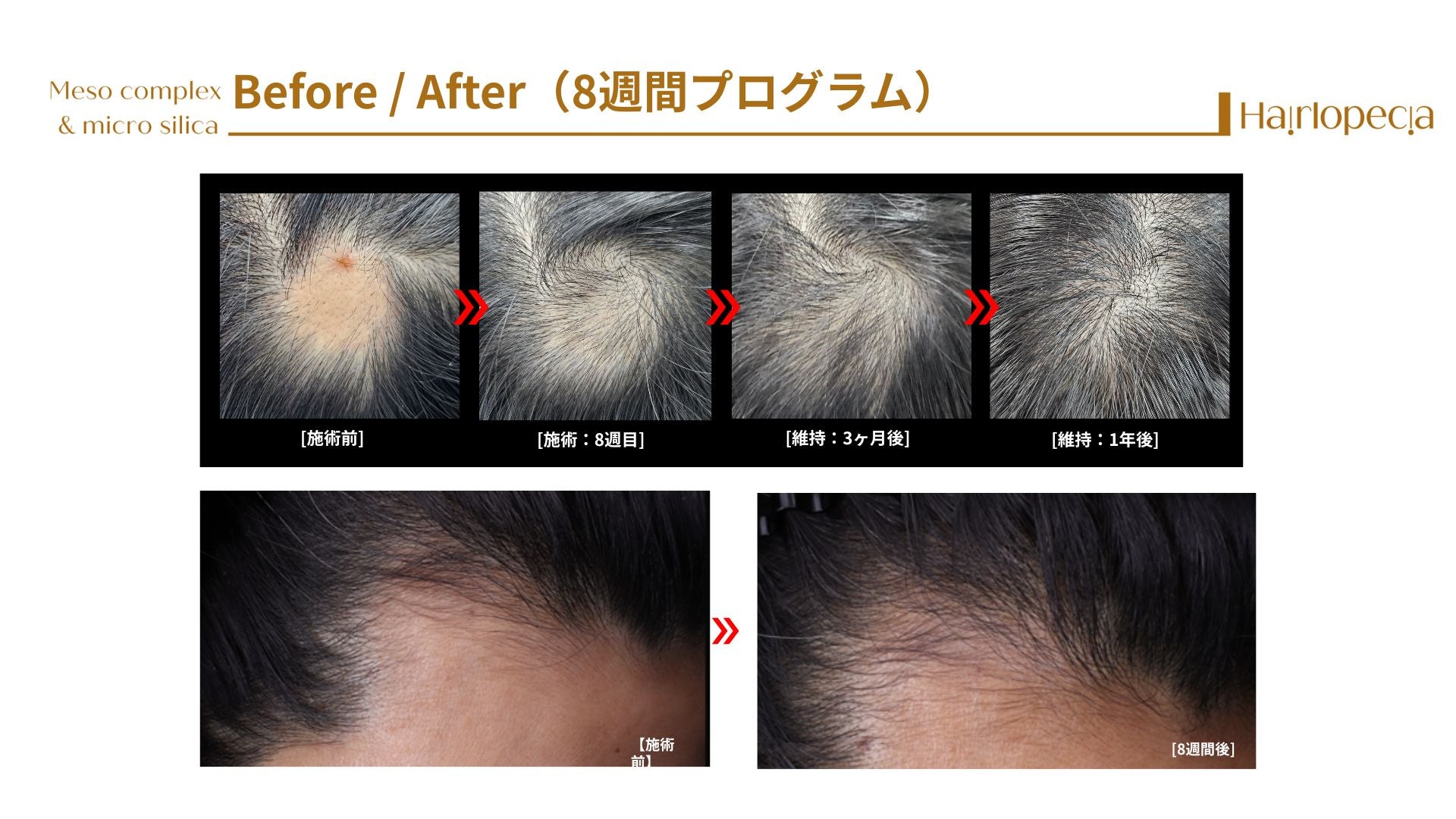 ヘアロペーシア（頭皮ケア用スピキュール）