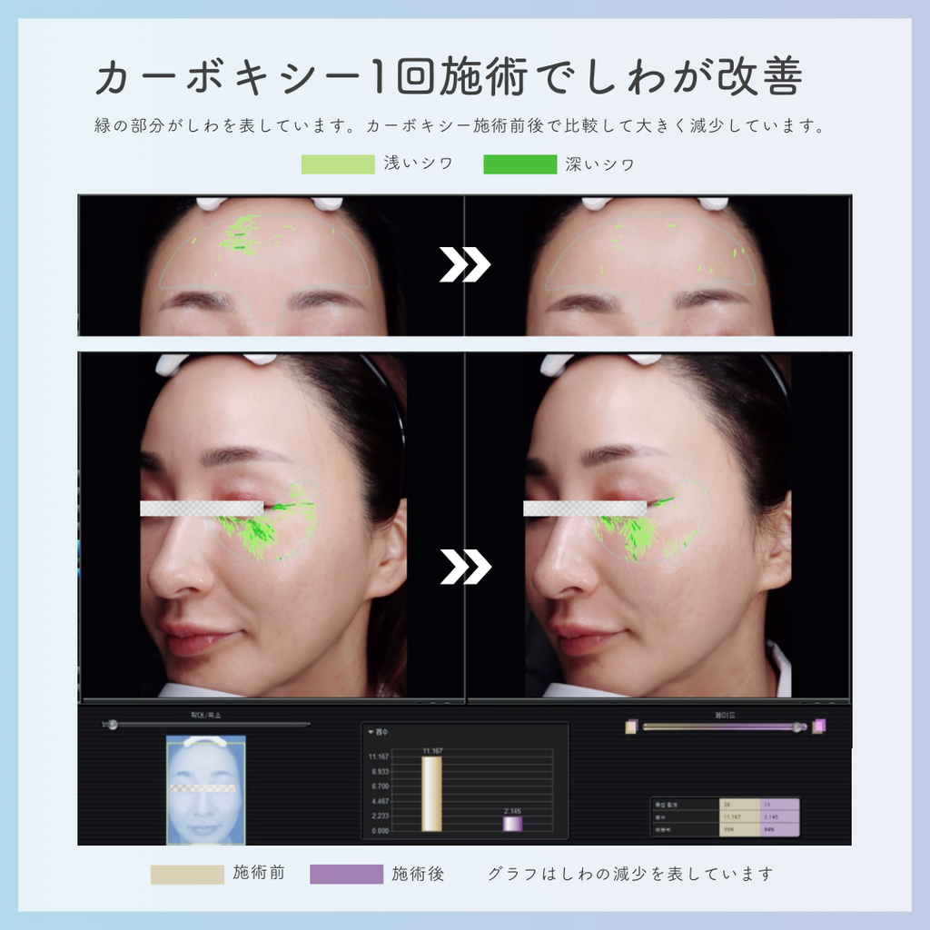 カーボキシー ミニキット 5回分