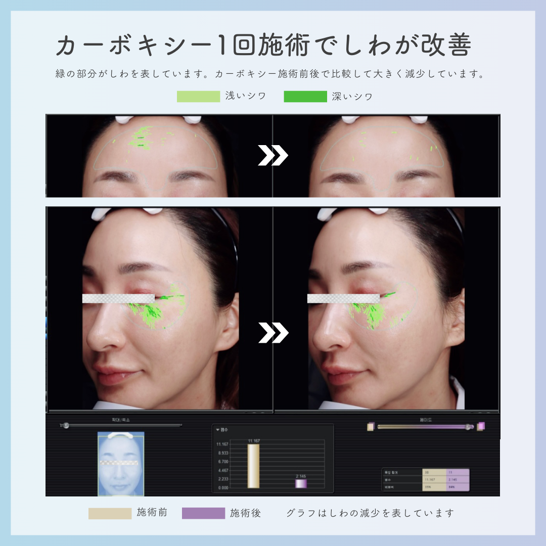 カーボキシー ミニキット 5回分